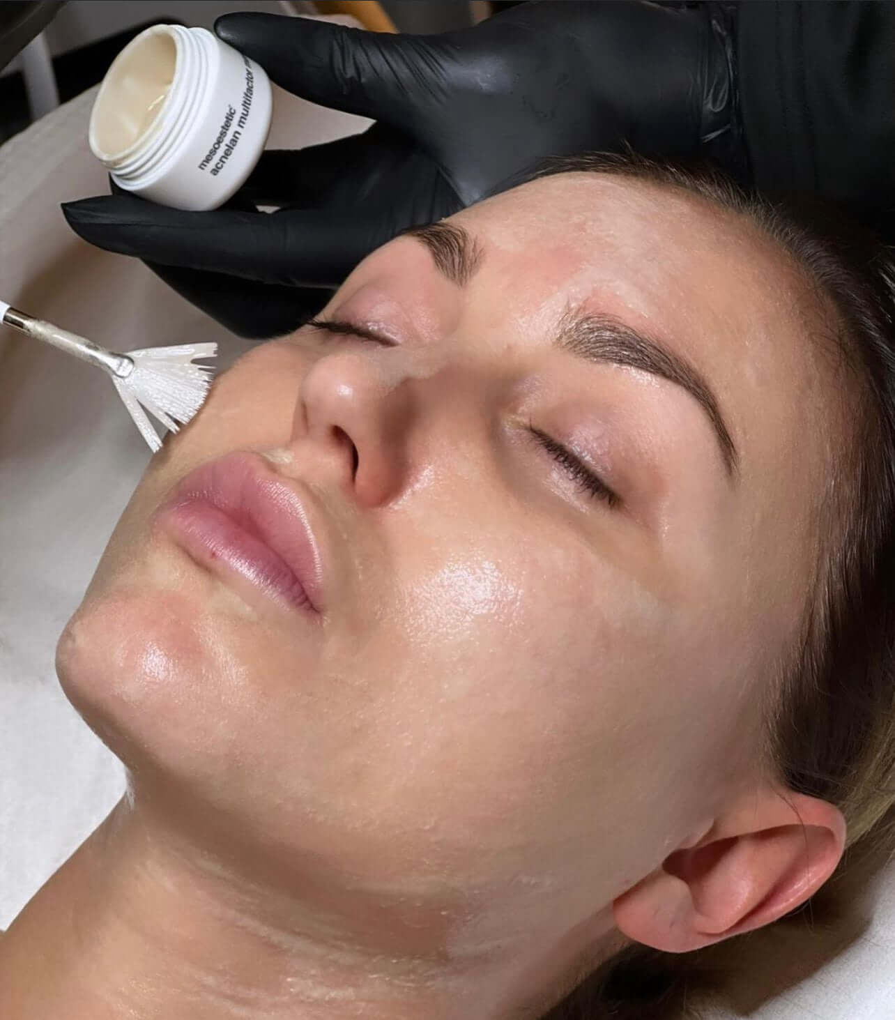 Acnelan fra Holistic Beauty – til avanceret hudpleje hos Holistic Beauty