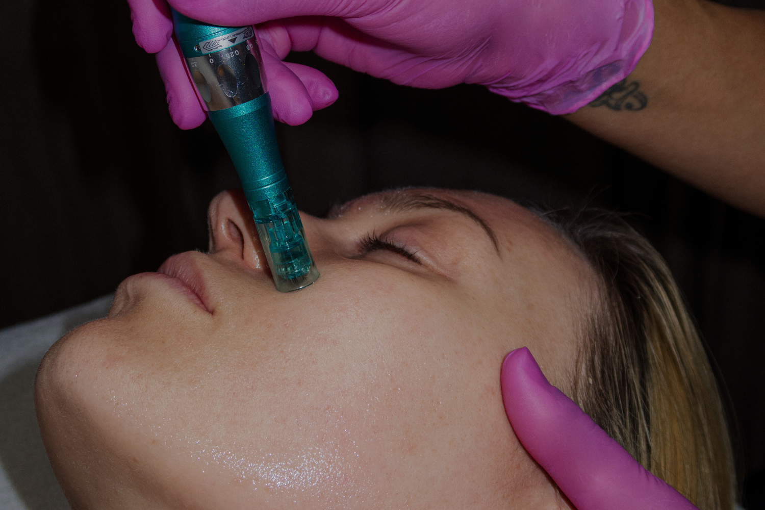 Microneedling: Hvad sker der i huden, og hvem er behandlingen til?