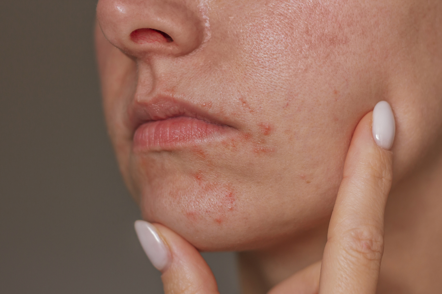 Perioral dermatitis: Når huden gør oprør