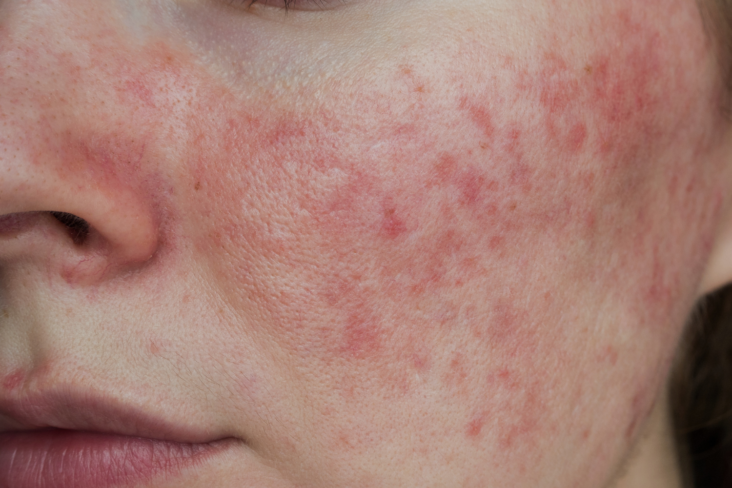 Rosacea: Årsager, triggere og behandling der faktisk hjælper