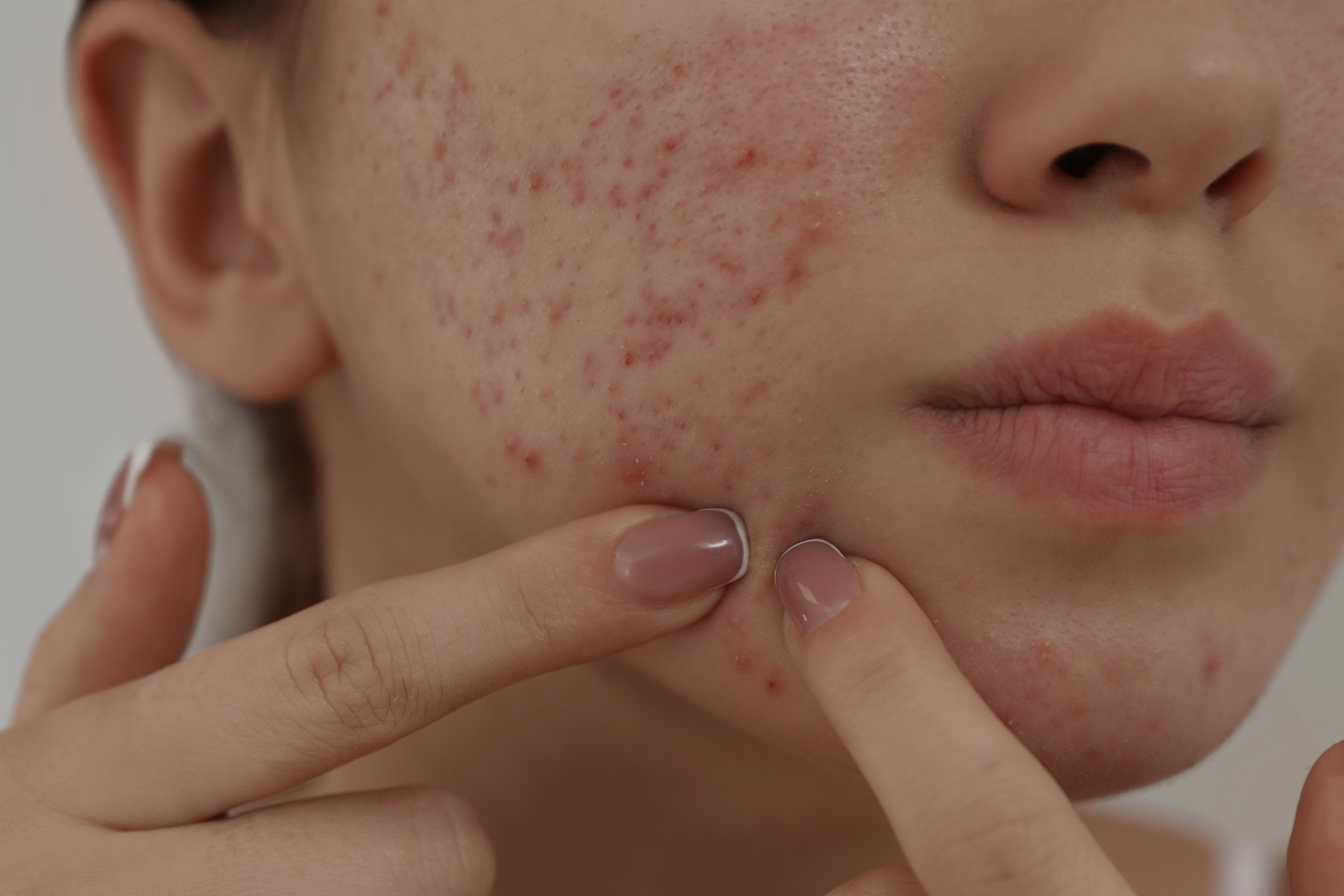 Acne hos voksne: Årsager, hormonelle sammenhænge og effektiv behandling