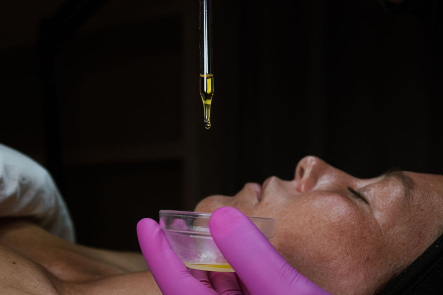 Kemisk peeling: En faglig guide til hudens fornyelse